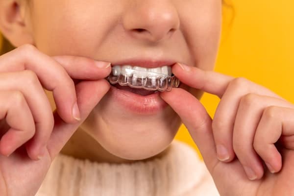 Depois — Clareamento Dental